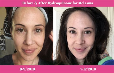 Hydroquinone for Melasma: My Before & After Pictures