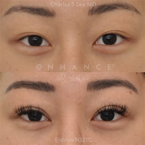 Asian Eyelid Surgery | Beverly Hills, CA | Charles S. Lee, MD