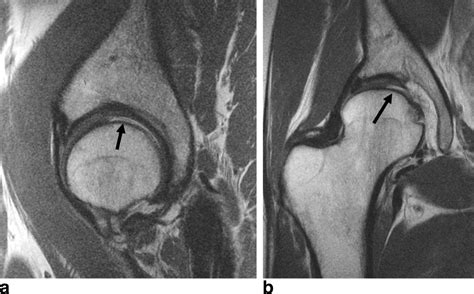 Acetabular Labrum Mri