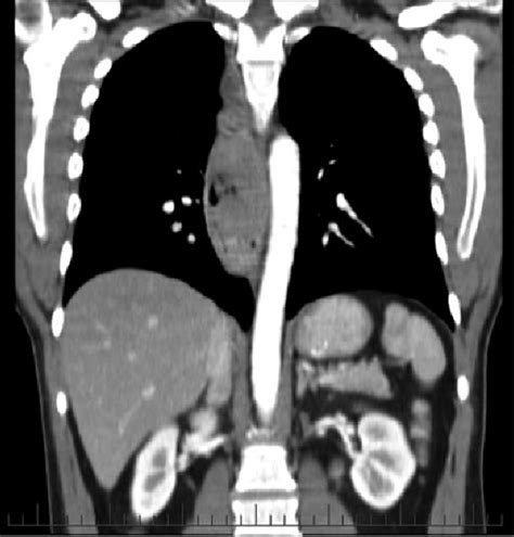 Extensive mediastinal lymphadenopathy on staging CT scan. | Download Scientific Diagram