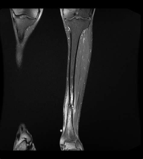 tibial stress fracture | The Bone School