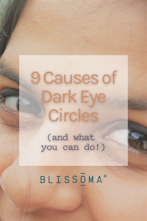 What Causes Dark Under Eyes - Infoupdate.org