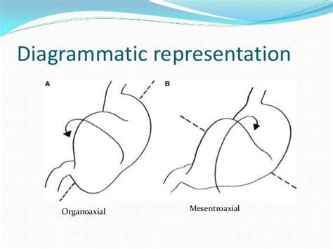 Gastric volvulus and other types of volvulus