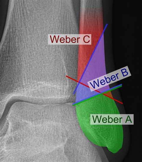 Weber Ankle Fracture - Classification | Treatment | Surgery