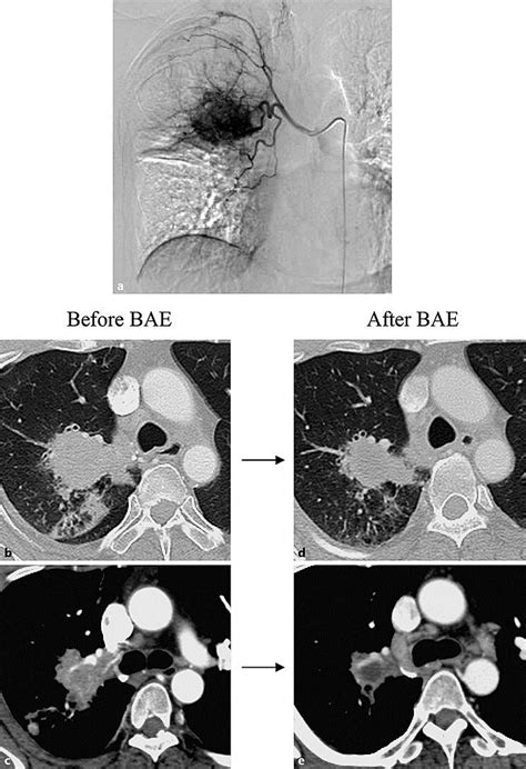 Findings on bronchial arteriography and chest CT before and after BAE ...