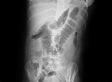 17: Colon cut-off sign on plain X-ray abdomen | Download Scientific Diagram