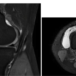 MRI Image showing synovial hypertrophy and effusion. | Download ...