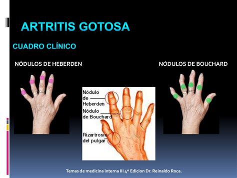 Artritis Gotosa