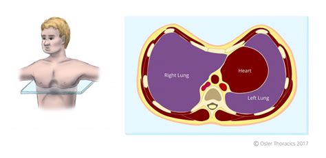 Pectus Excavatum Brace Pectus Excavatum Vacuum Bell Pectus Excavatum 21760 | The Best Porn Website