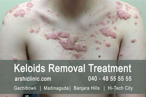 Keloids Removal Treatment in Hyderabad - Arshi Clinic