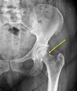 A 55-Year-Old Female with Hip Pain - Page 2 of 2 - Journal of Urgent ...