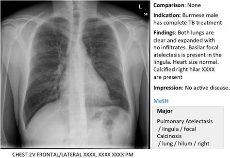 An example of OpenI [2] chest x-ray image, report, and annotations ...