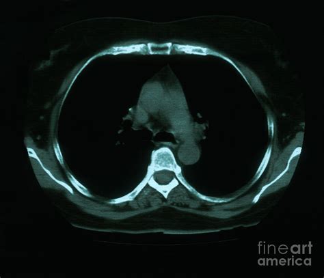 Granuloma & Calcification In Lung Photograph by Science Source