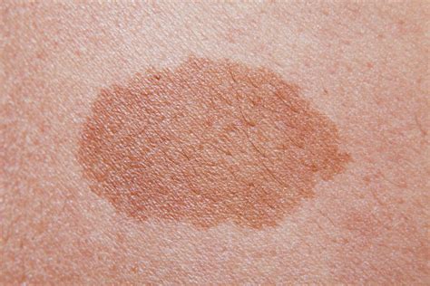 Is it normal for a new mole to appear? Causes and warning signs