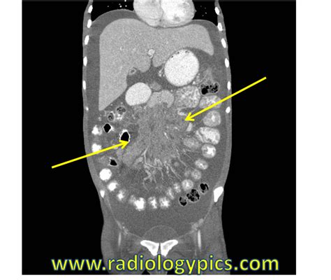 Solution to Unknown Case #21 – Mesenteric Lymphadenopathy Differential Diagnosis | RADIOLOGYPICS.COM