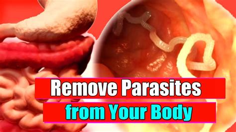 Remove Parasites from Your Body super fast! Threadworms Treatment - YouTube