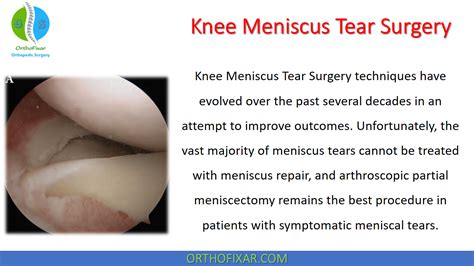 Knee Meniscus Tear Surgery | OrthoFixar 2024