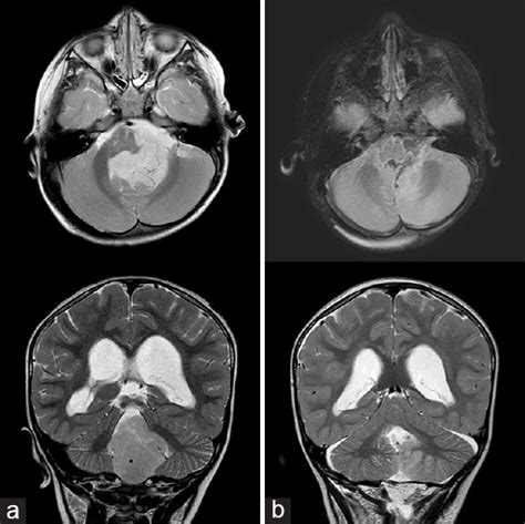 Surgical Neurology International