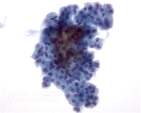 follicular neoplasm cytology