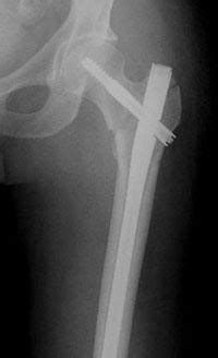 Hip ORIF – Modern Orthopaedics of New Jersey