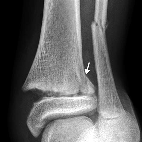 Salter-Harris fractures[3 of 3]