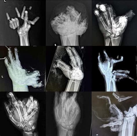 X-Rays of hands after firework accidents : r/BeAmazed