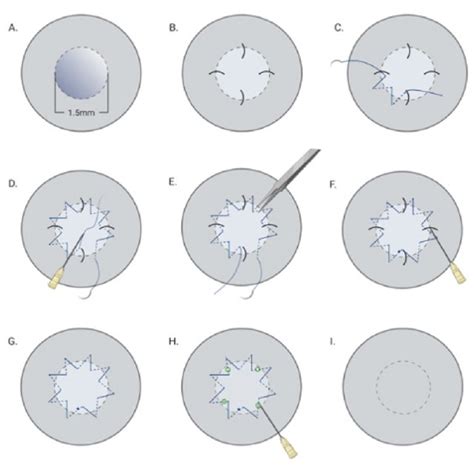 Schematic drawing of running suture placement. A. Mark the recipient... | Download Scientific ...