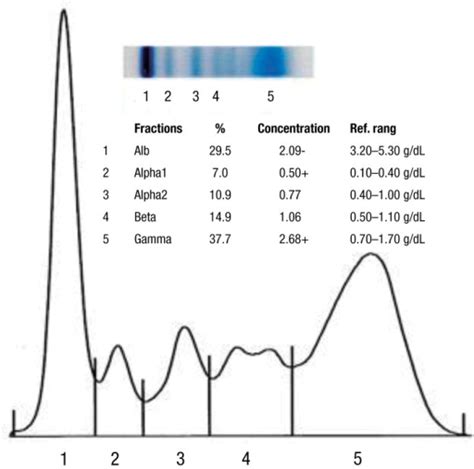 The result of serum protein electrophoresis showing ele | Open-i