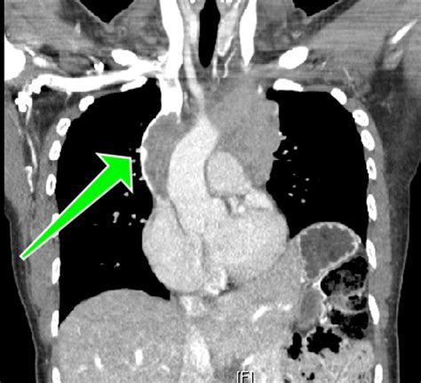 Superior Vena Cava Syndrome - The Emergency Medical Minute