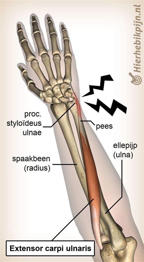 Extensor carpi ulnaris tendinopathie | Hier Heb Ik Pijn