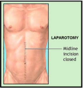 Abdominal Aortic Aneurysm Singapore | Stenting Treatment