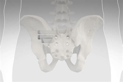 Minimally Invasive Sacroiliac Joint Fusion - Carl Spivak, MD ...