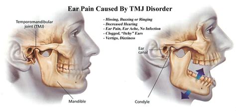 Ear Pain & Ringing | Head Pain Institute