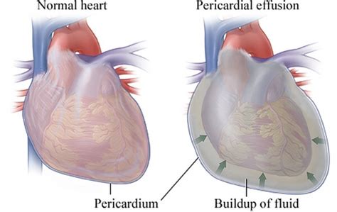 Pericarditis Disease with Causes, Test and Nursing Intervention