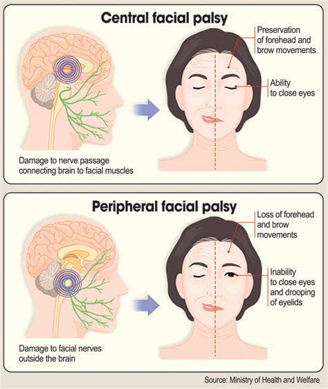 Viral infection may cause facial palsy - The Korea Times