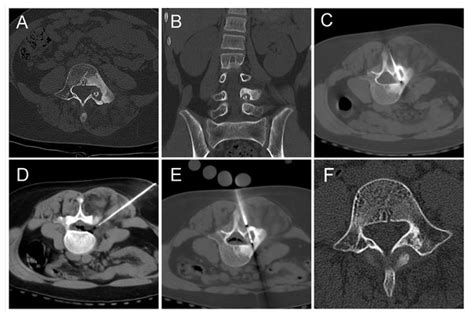 A preliminary comparative study of percutaneous CT-guided cryoablation ...