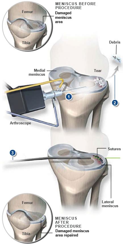 Meniscus Repair | Central Coast Orthopedic Medical Group