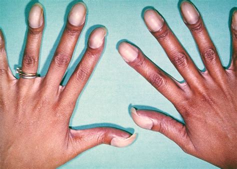 Nail clubbing is a deformity of the fingers and fingernails that ...