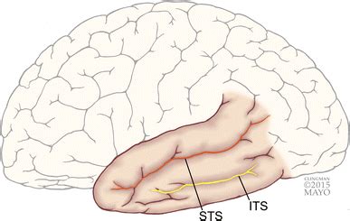 Surface anatomy of the temporal lobe, lateral view. The superior... | Download Scientific Diagram