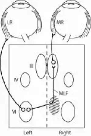 Internuclear ophthalmoplegia - American Academy of Ophthalmology