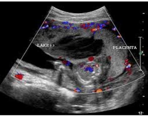 Venous Lake Placenta