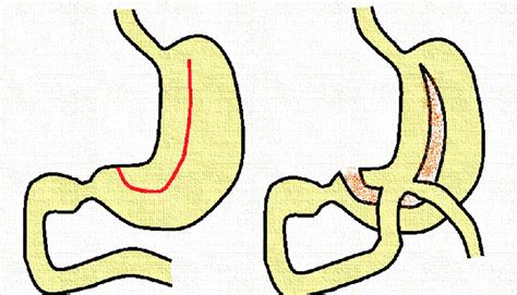 Schematic presentation of gastric resection and formation of... | Download Scientific Diagram