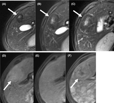 The magnetic resonance imaging (MRI) findings. A‐C, Superparamagnetic ...