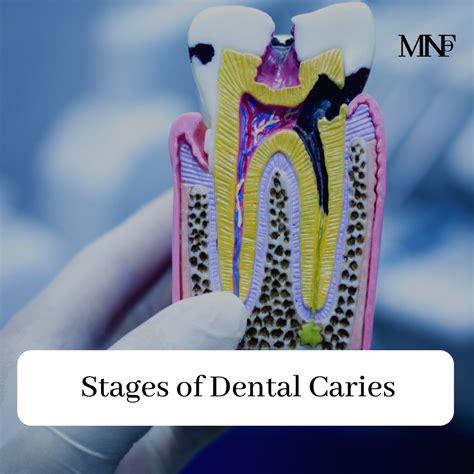 Stages of Dental Caries - Smile Specialists