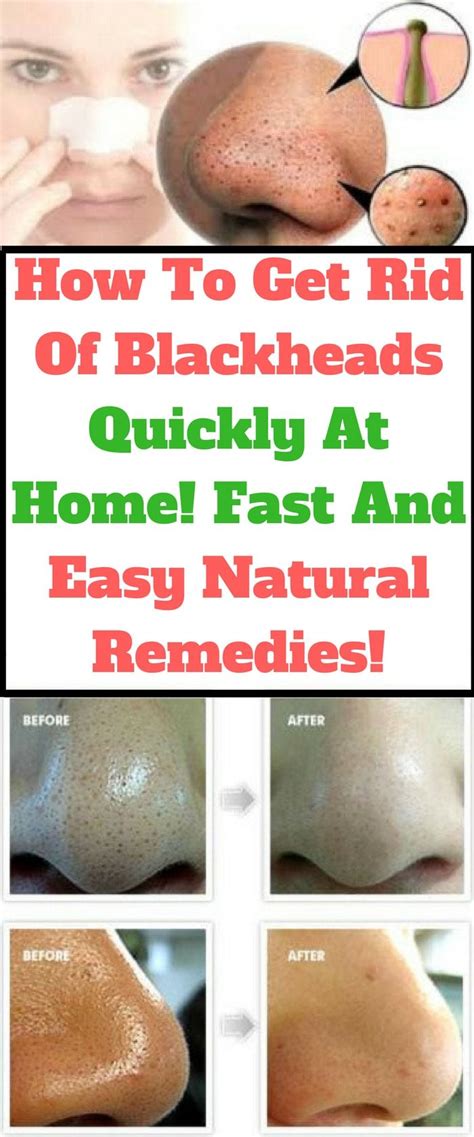 How To Get Rid Of Blackheads Quickly At Home! Fast And Easy Natural Remedies! | Natural remedies ...