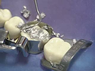 Pediatric Dentistry: Silver Fillings (Amalgam)