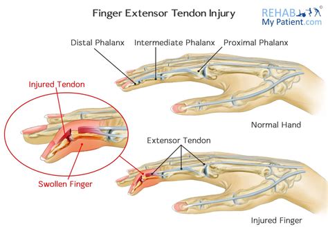 Finger Extensor Tendon Injury | Rehab My Patient