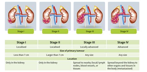 Images/Graphics Kidney Cancer - IKCC - International Kidney Cancer ...