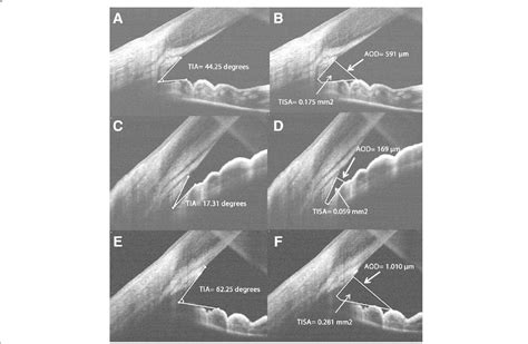 Examples of iridocorneal angle measurements made by Fourier Domain... | Download Scientific Diagram