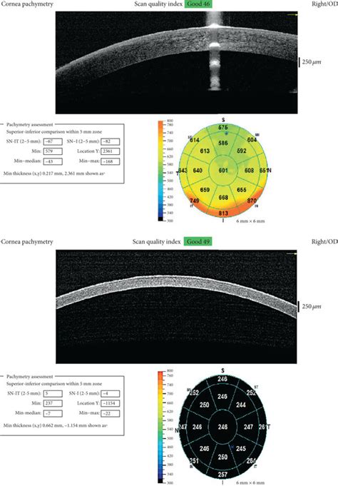 Anterior segment OCT showing corneal thickness maps of both eyes. The ...